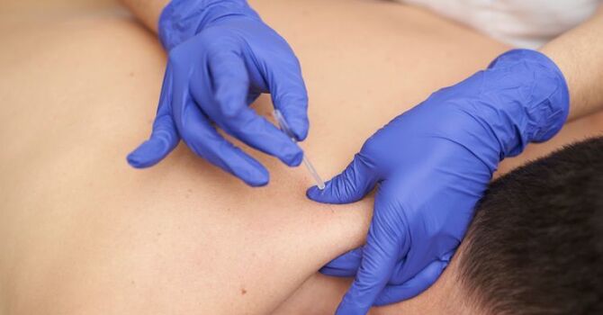 Dry Needling for Sports Injuries: How It Speeds Up Recovery image